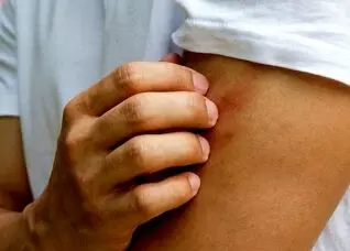 چرا پشه‌ها بعضی افراد را بیشتر از دیگران نیش می‌زنند؟