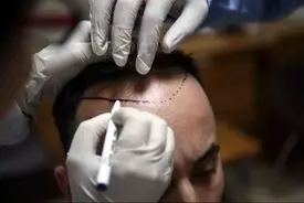 چگونه استانبول به پایتخت کاشت موی جهان بدل شد؟